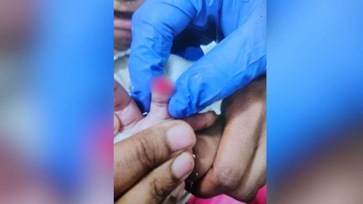 अस्पताल की रोंगटे खड़े करने वाली लापरवाही... ड्रेसिंग हटाते समय काट दी 6 महीने के मासूम की उंगली
