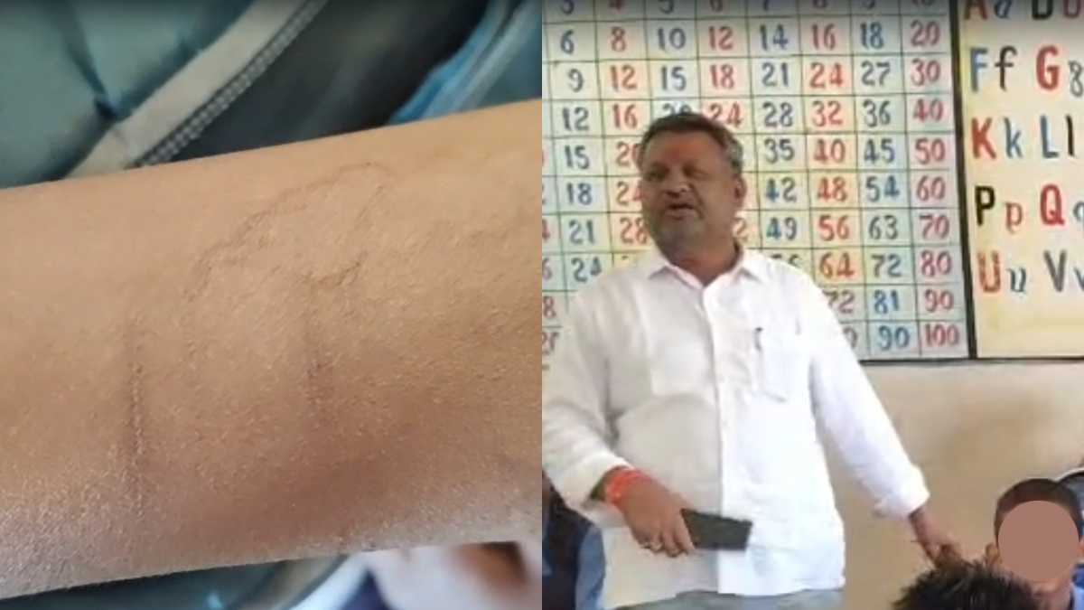 एक साथ 35 बच्चों ने काटा हाथ, शिक्षकों ने देखा तो मचा बवाल, मेडिकल टीम ने की जांच
