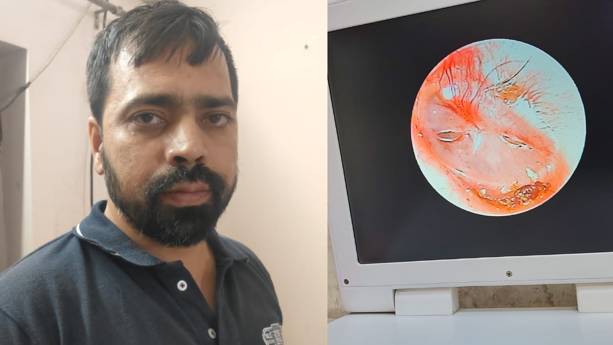 खाकी की हैवानियत: पत्नी की शिकायत पर पुलिस ने पति को बेरहमी से पीटा, फाड़ दिया कान का पर्दा