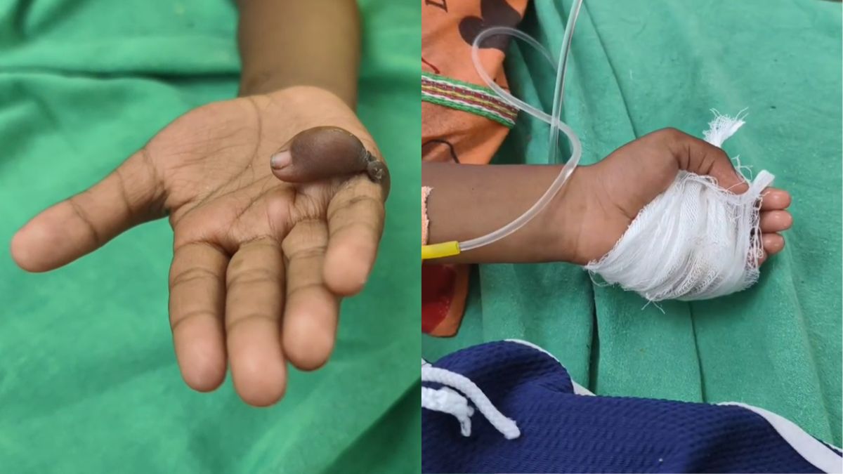 निकालनी थी दायें हाथ की छठी उंगली, निकाल दी बायें हाथ की उंगली; परिजनों की शिकायत पर जांच शुरू