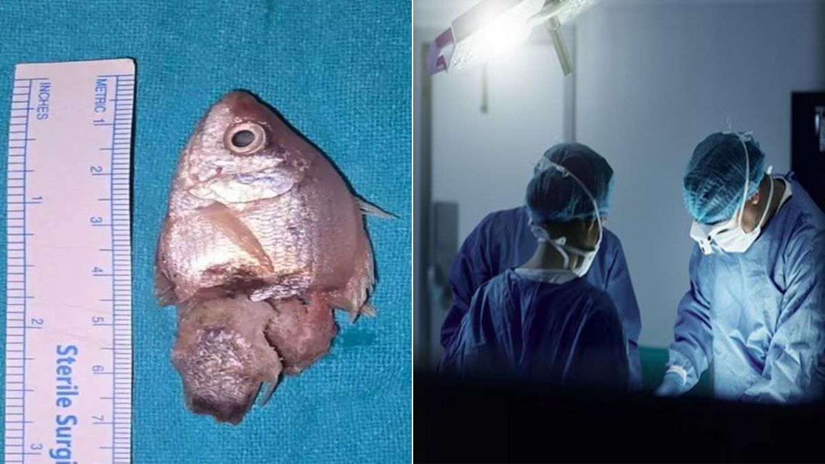 एक साल के बच्चे ने निगली 3 इंच की जिंदा मछली, गले में फंसी; घर में एक्वेरियम साफ करने के दौरान हादसा