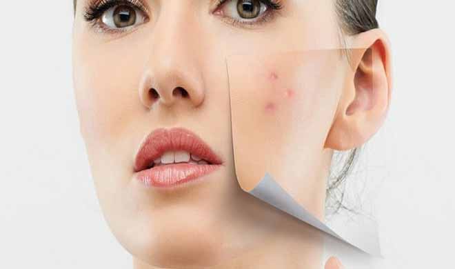 pimples pimples- India TV