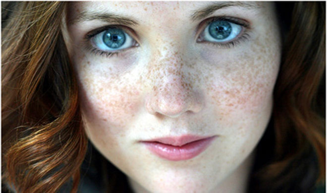 pigmentation face pigmentation face- India TV