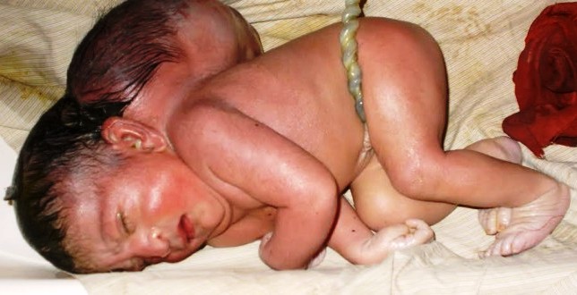 2 headed baby 2 headed baby- India TV