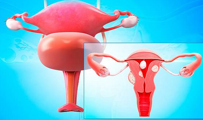 Ovarian Cancer Ovarian Cancer- India TV