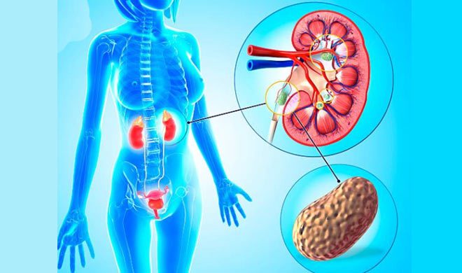kidney stone kidney stone- India TV