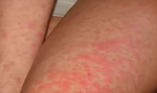 skin skin- India TV