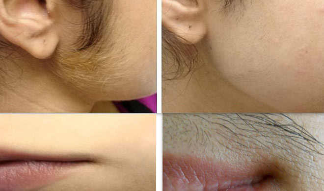 Unwanted hair Unwanted hair- India TV