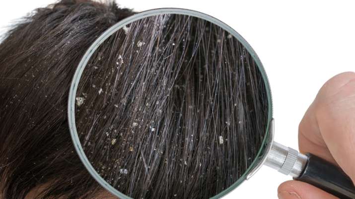 dandruff dandruff- India TV