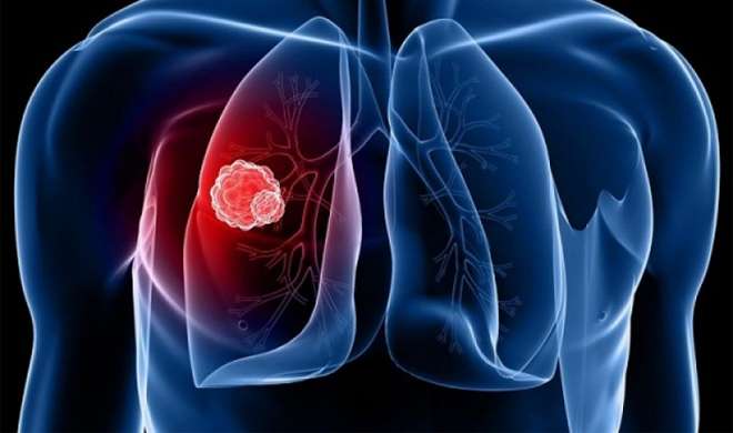 Lung Cancer Lung Cancer- India TV