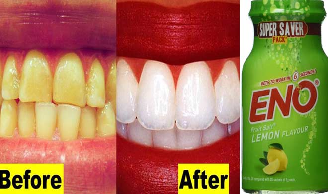 yellow teeth yellow teeth- India TV