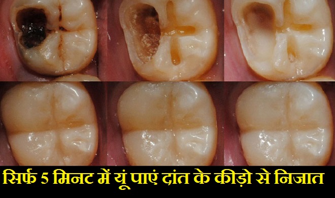 TEETH TEETH- India TV