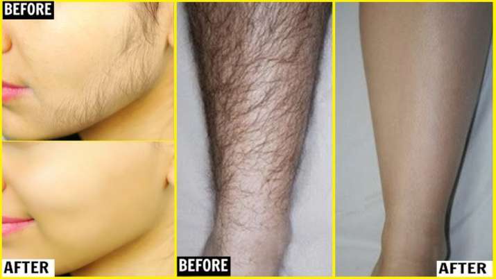 unwanted hair remover unwanted hair remover- India TV
