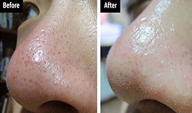 black heads black heads- India TV