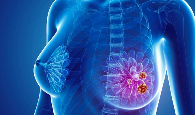 Breast cancer Breast cancer- India TV