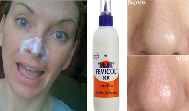 glue fevicol to remove blackheads glue fevicol to remove blackheads- India TV