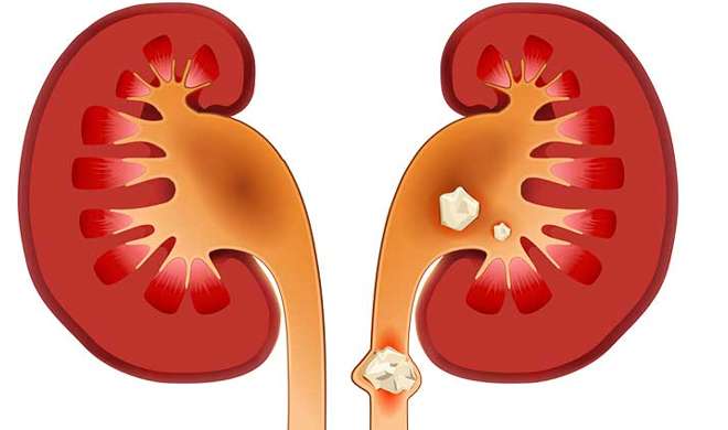 kidney kidney- India TV