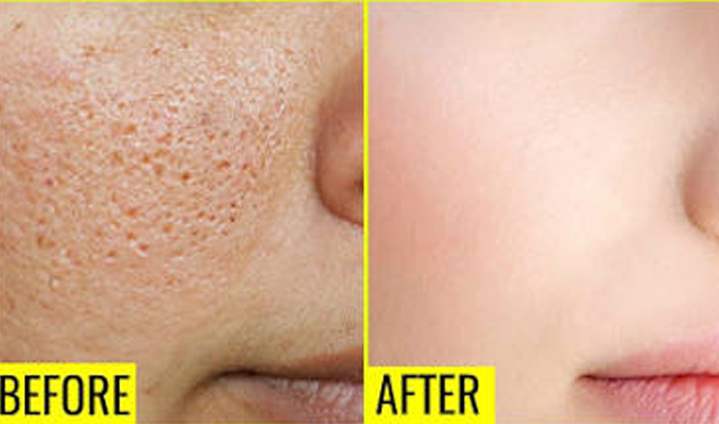 large pores large pores- Khabar IndiaTV