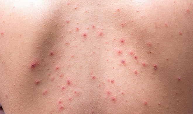 skin problem skin problem- India TV