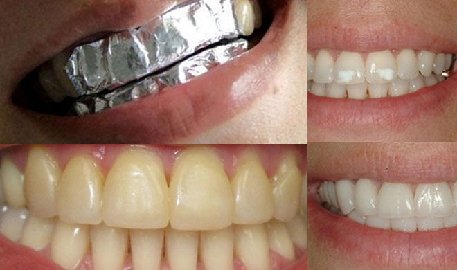 teeth teeth- Khabar IndiaTV
