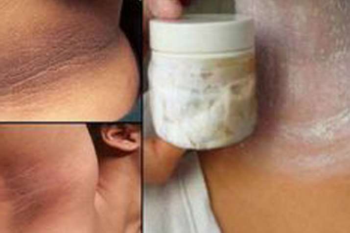 home remedies home remedies- India TV