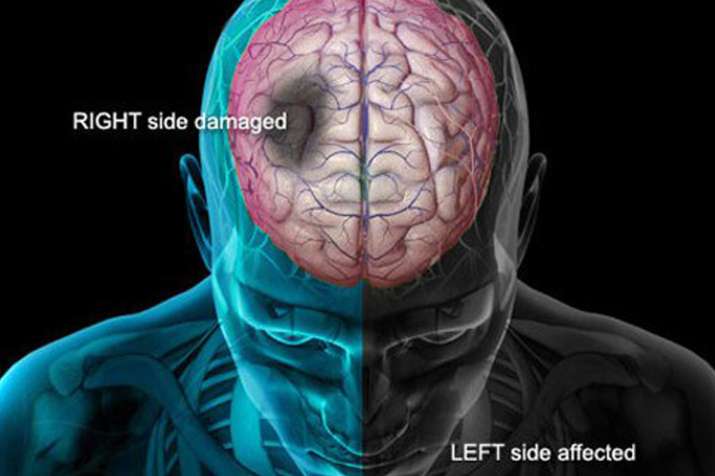 brain stroke brain stroke - India TV