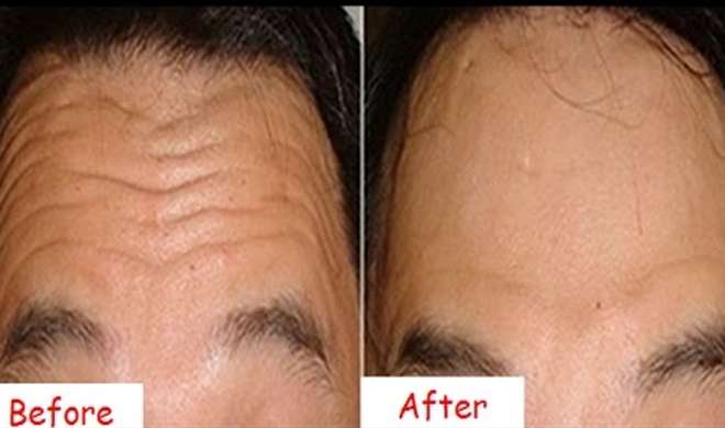 forhead forhead- Khabar IndiaTV