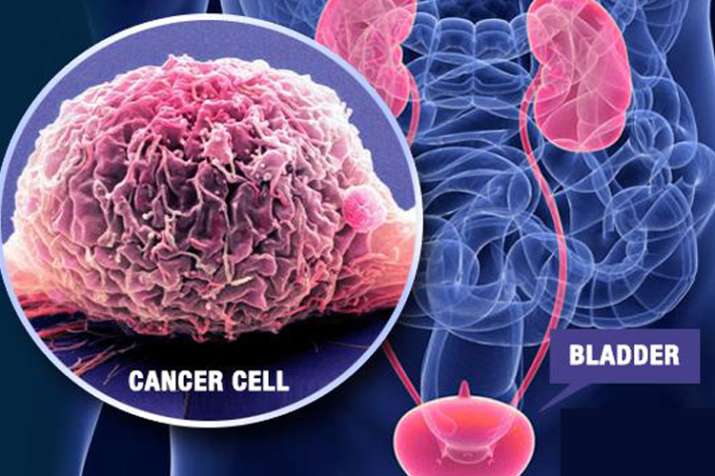 bladder cancer bladder cancer- India TV