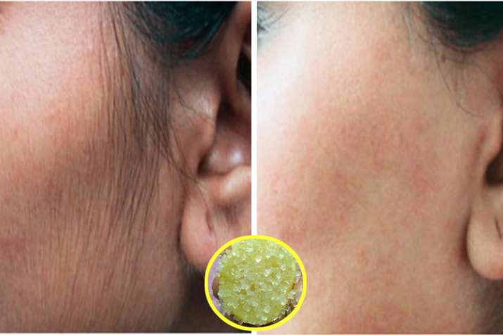 Hair Remover Remdy Hair Remover Remdy- Khabar IndiaTV