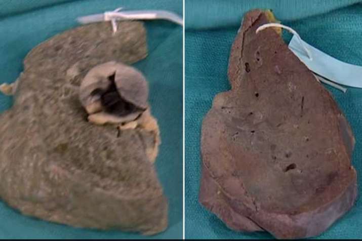 Liver Liver- Khabar IndiaTV