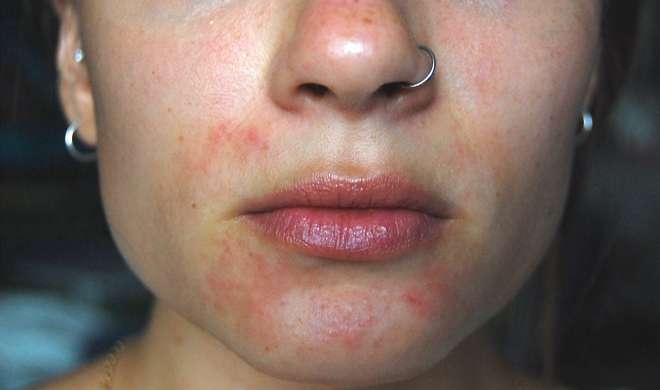 skin problem skin problem- India TV