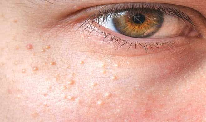 skin problem skin problem- India TV