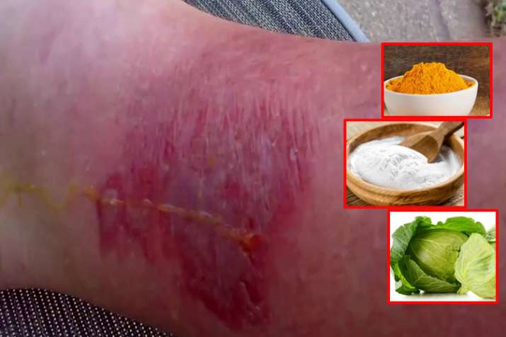 Effective Home Remedies for Spider Bites in hindi Effective Home Remedies for Spider Bites in hindi- India TV