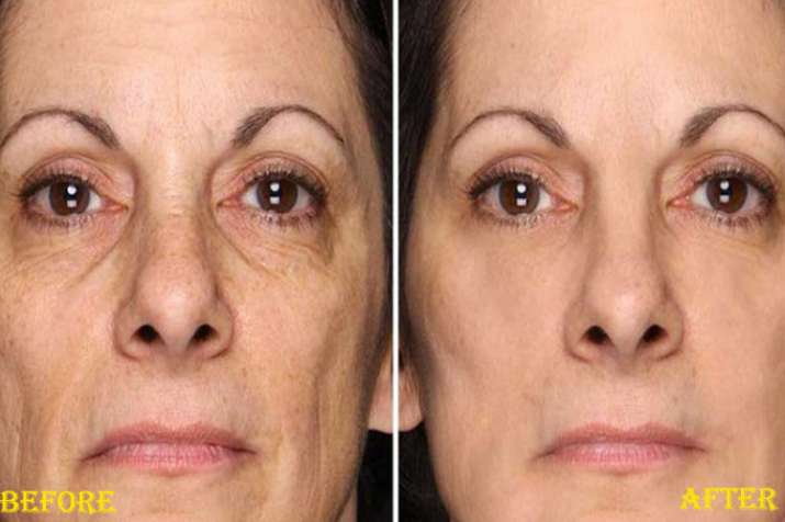 Home remedies to remove wrinkles Home remedies to remove wrinkles- Khabar IndiaTV