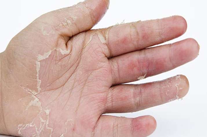 skin peeling skin peeling- India TV