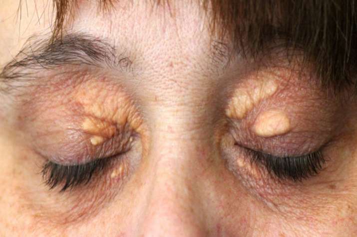 eyes problem eyes problem- India TV