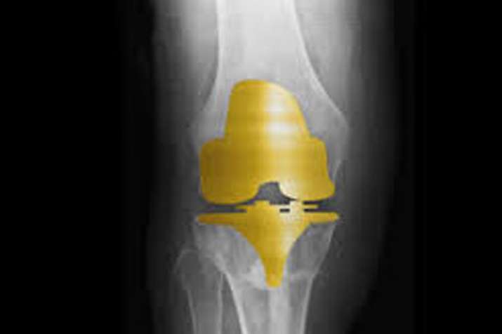 Golden Knee Implant Golden Knee Implant- India TV