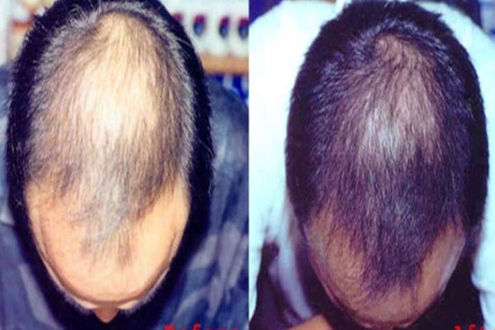 Hair Hair- India TV