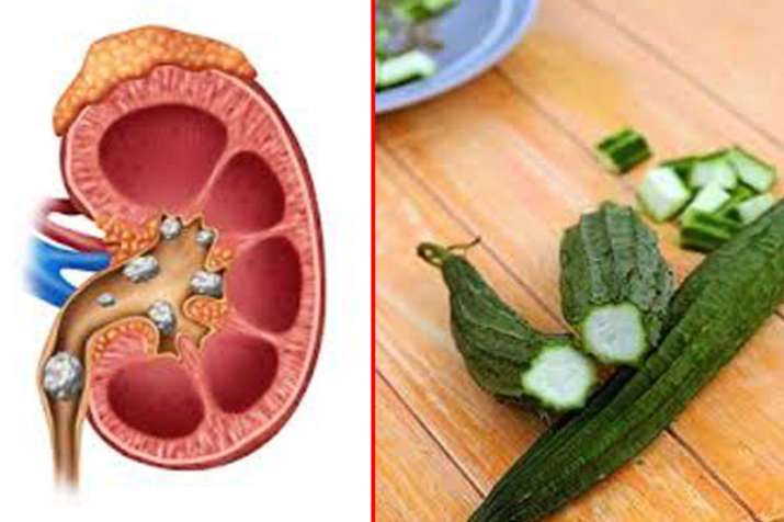 kidney stone kidney stone- India TV