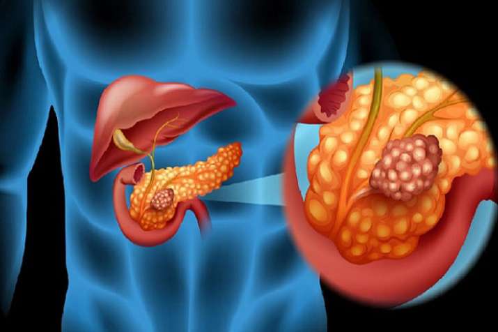 pancreatic cancer pancreatic cancer - Khabar IndiaTV