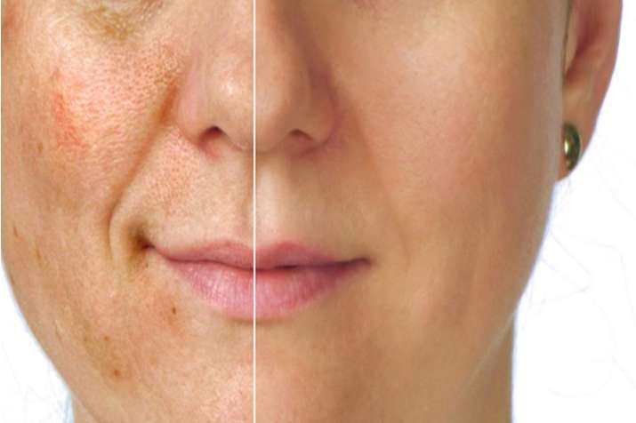 skin care tips skin care tips- India TV