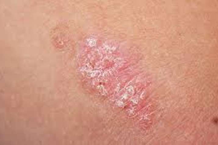 skin cancer skin cancer- India TV