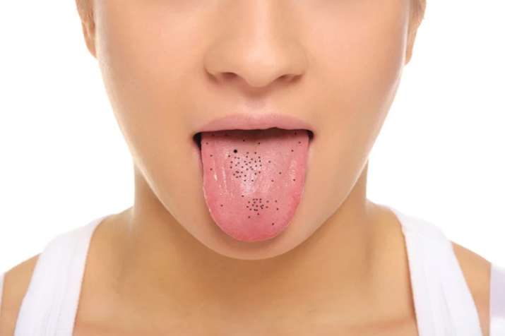 black spots on your tongue black spots on your tongue- Khabar IndiaTV