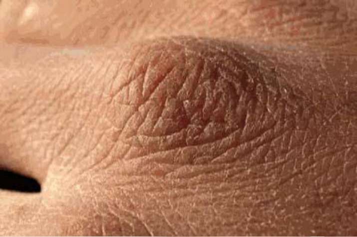skin problem skin problem- India TV