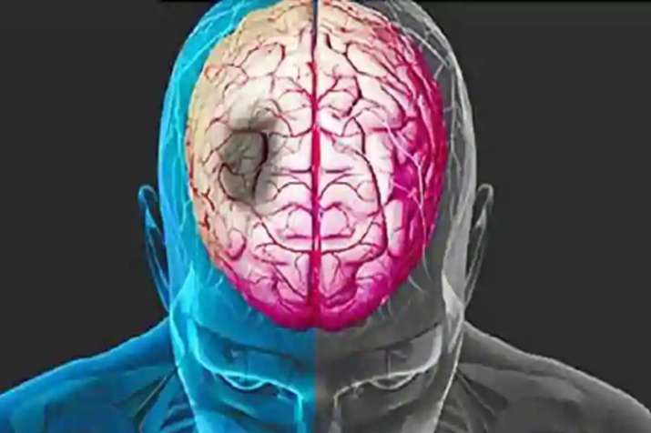 brain stroke brain stroke- India TV