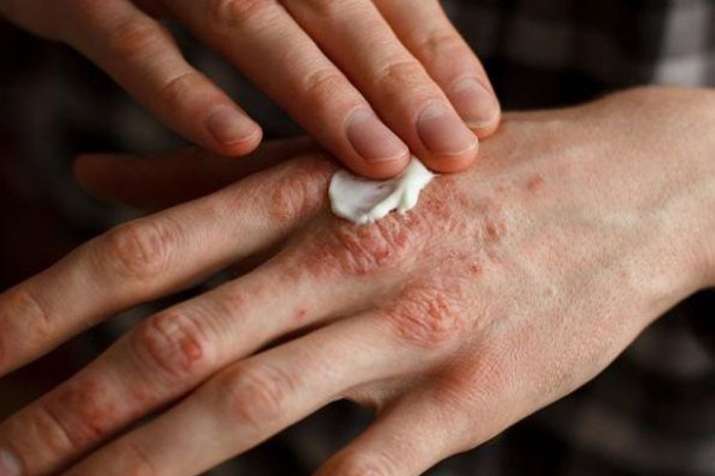 world psoriasis day world psoriasis day- India TV