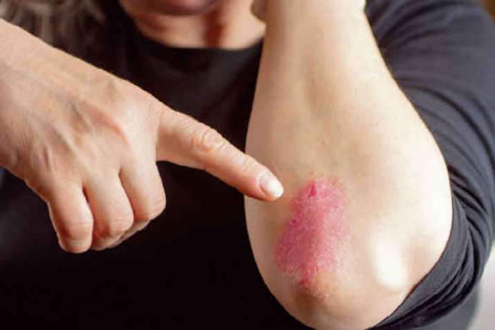 psoriasis psoriasis- India TV