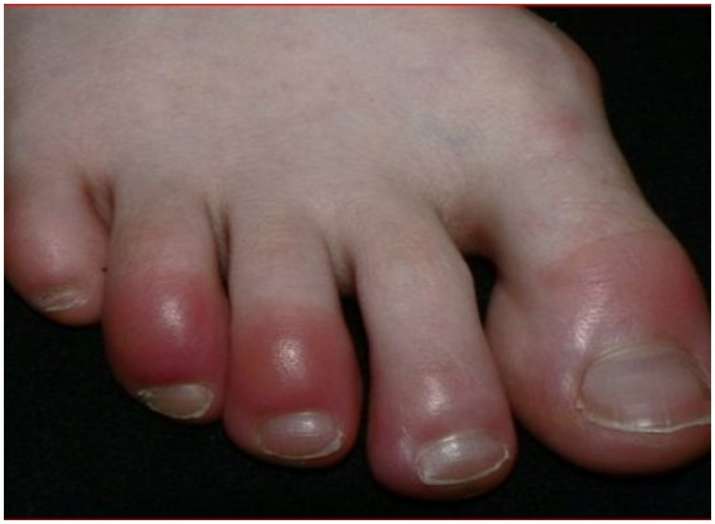 Swelling on feet Swelling on feet- India TV
