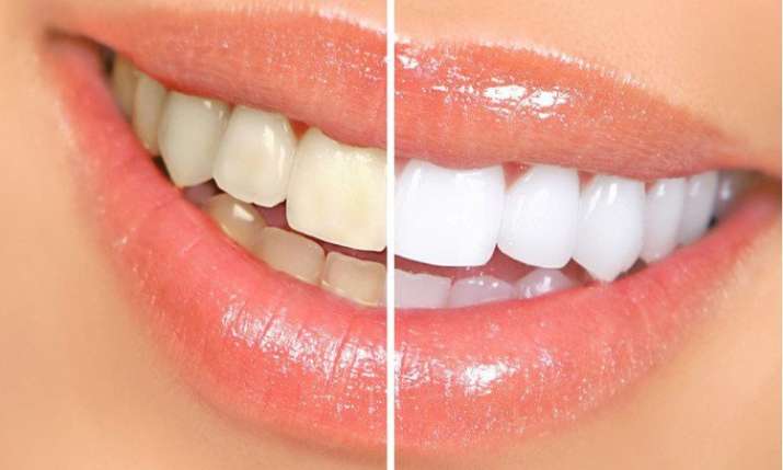 yellow teeth yellow teeth- India TV