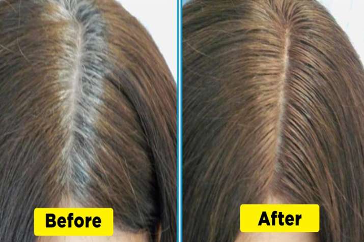 hair problem hair problem- India TV